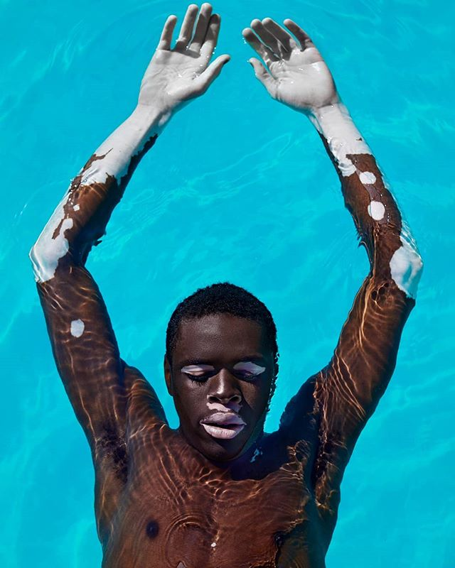 Moostapha model with vitiligo in the pool